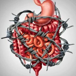 syndrome-colon-irritable